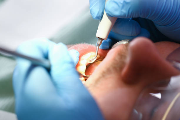 Best Emergency Dental Care for Broken or Chipped Teeth in Richland, MO